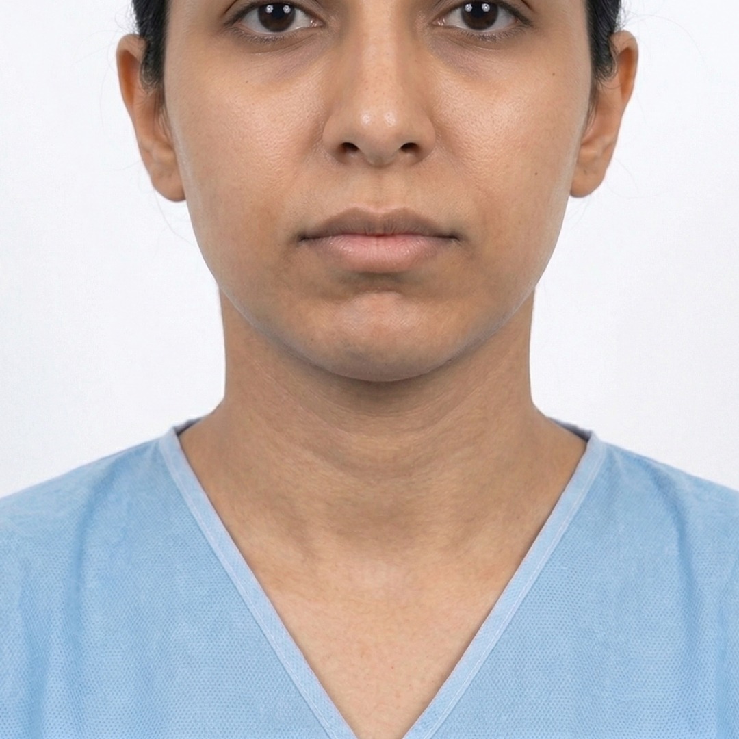 Frontal view showing the successful result of a Deep Plane Facelift with restored cheek volume, a sharp jawline, and smoother skin texture at Dina Elite clinic.