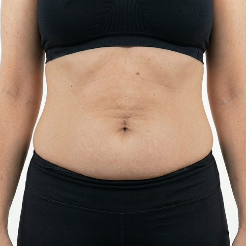 Visible abdominal fat reduction and improved body contour after a non surgical Fat Freezing session at Maraya Clinic 