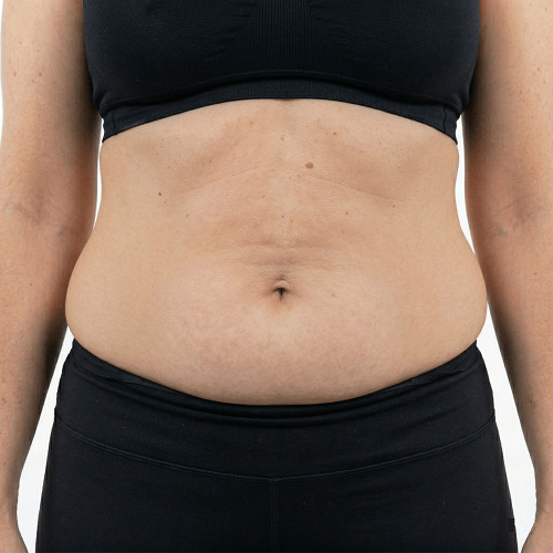 Close up frontal view of a patient's abdomen with stubborn fat deposits and clinical markings before a Fat Freezing treatment at Maraya Clinic 