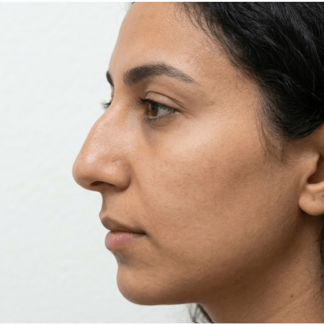 Close-up profile view of a young woman before rhinoplasty surgery at Dina Elite in Egypt, showing a prominent nasal hump and ptotic tip.