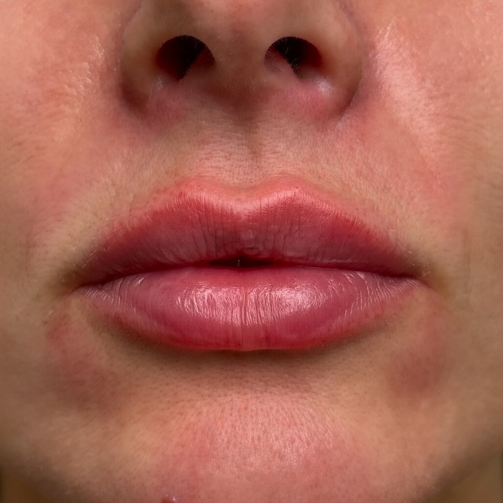 Post-operative results of a surgical Lip Lift at Dina Elite, showing a shortened philtrum, enhanced upper lip volume, and a youthful pout.