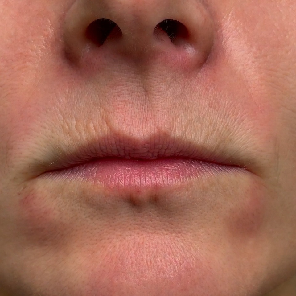 Close-up clinical view of a patient before a Lip Lift procedure, showing a long philtrum and thin upper lip with visible aging lines.