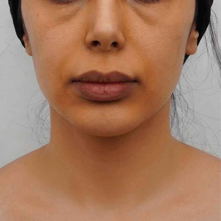 Close-up frontal view showing smooth, rejuvenated skin on the neck with a defined jawline after advanced muscle tightening and double chin removal in Egypt. Minimal visible scarring. Target market: GCC elite. 1:1 aspect ratio.