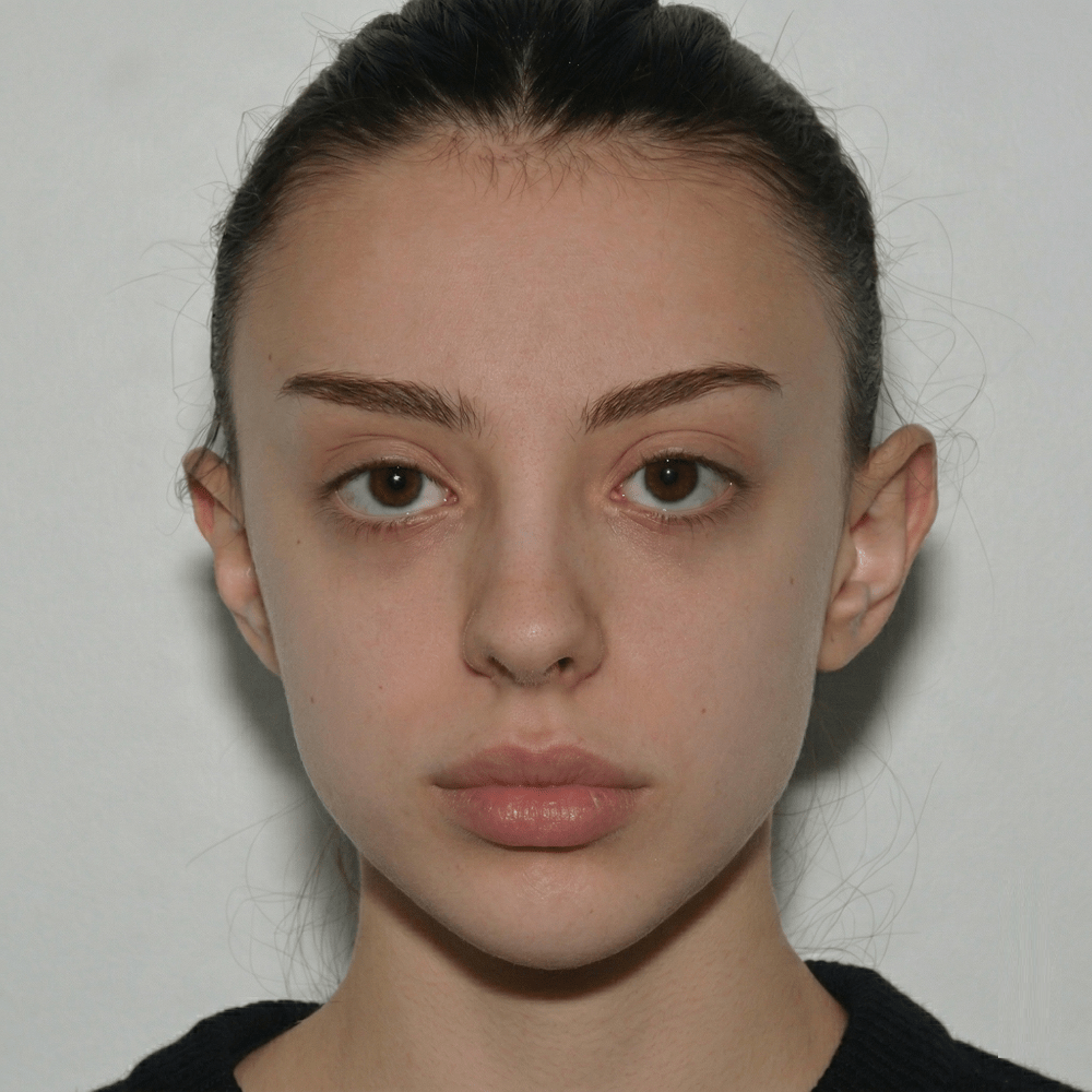 ALT Text: Post-operative results of orthognathic surgery showing perfect facial symmetry and a balanced jawline, Dina Elite Luxury Medical Aesthetics.