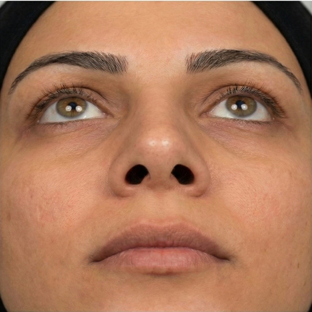 Focused clinical close-up of the exact same nose after Septo-Turbinoplasty, showcasing a perfectly aligned, straight nasal bridge and tip, with an illustrating a corrected, open airway.