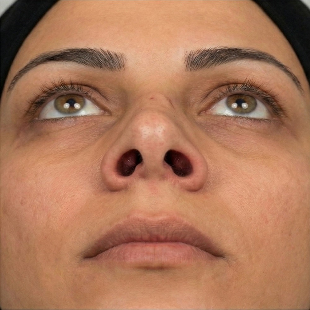 Pre-operative assessment: Obstructive breathing due to severe septal deviation and turbinate hypertrophy in a 30 years old female patient before surgery