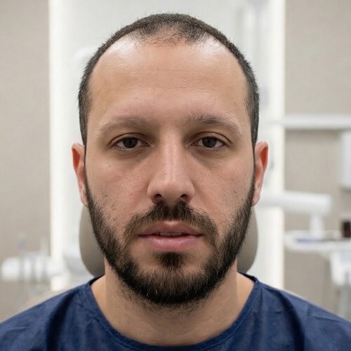 Post operative results of a male beard and eyebrow transplant at Dina Elite, showing a full, dense, and well defined beard with perfectly contoured eyebrows 