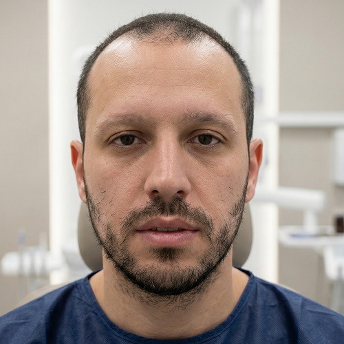 Frontal clinical view of a male patient before facial hair restoration at Dina Elite, showing a patchy beard, significant cheek gaps, and naturally thin, sparse eyebrows 