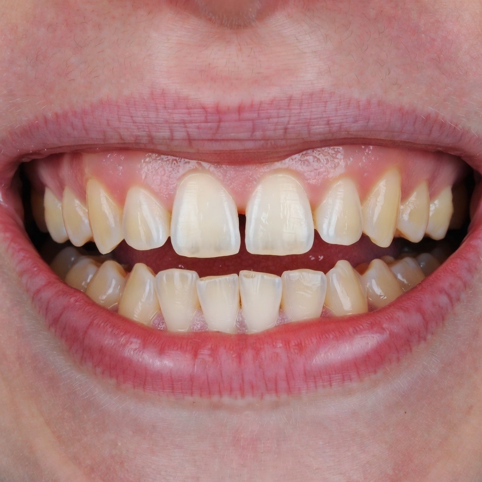 Close up of a patient's smile before Gummy Smile Treatment at Dina Elite, Cairo, showcasing excessive upper gum tissue and short looking natural teeth crowns 