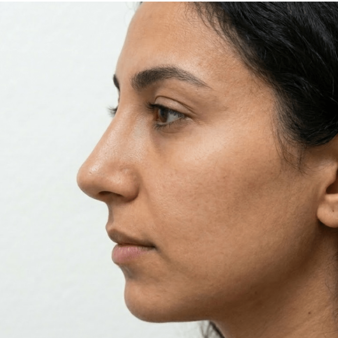 Close up profile view of the same young woman one year after custom rhinoplasty at Dina Elite in Egypt, showing natural looking, refined nasal structure and optimized tip projection 