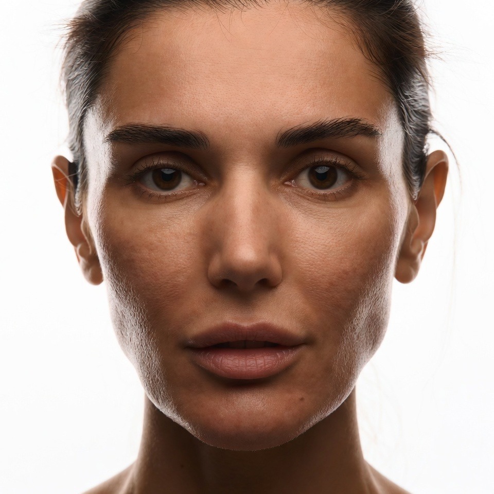 Clinical close up of a patient showing signs of skin dehydration, fine lines, and loss of radiance before Profhilo bio remodeling treatment at Maraya Clinic, Cairo, under Dr  Dina Khalil’s supervision 