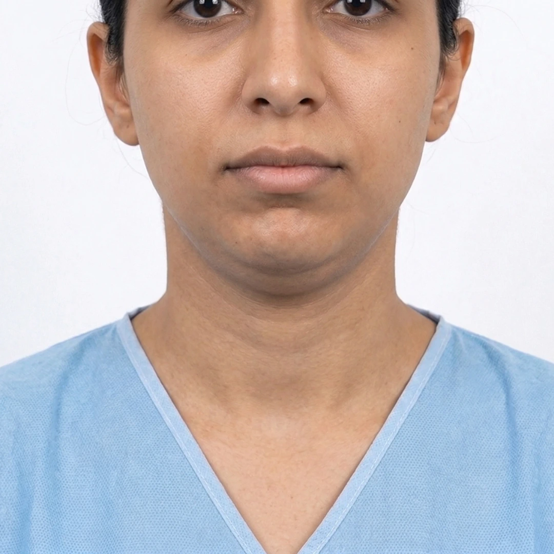 Frontal view of a Middle Eastern female patient showing facial sagging, nasolabial folds, and loss of jawline definition before a Deep Plane Facelift at Dina Elite clinic 