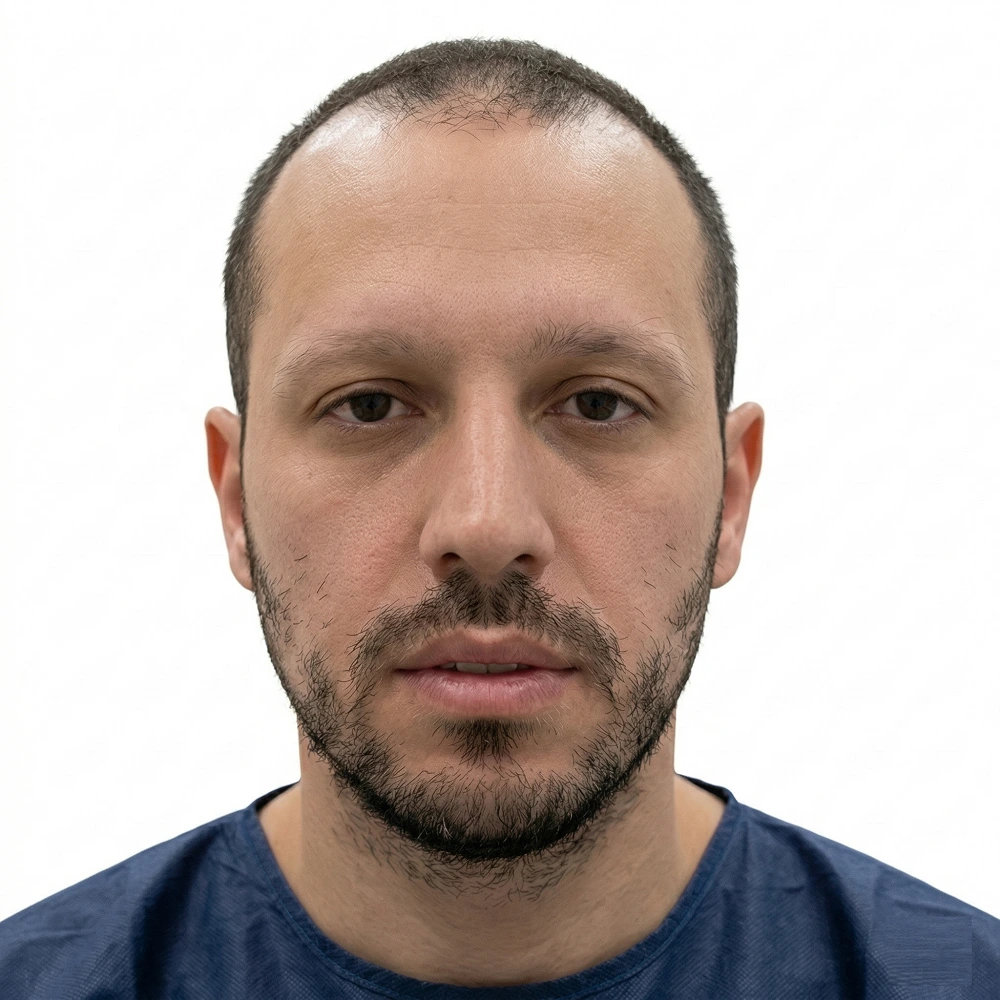 Frontal clinical view of a male patient before facial hair restoration at Dina Elite, showing a patchy beard, significant cheek gaps, and naturally thin, sparse eyebrows 