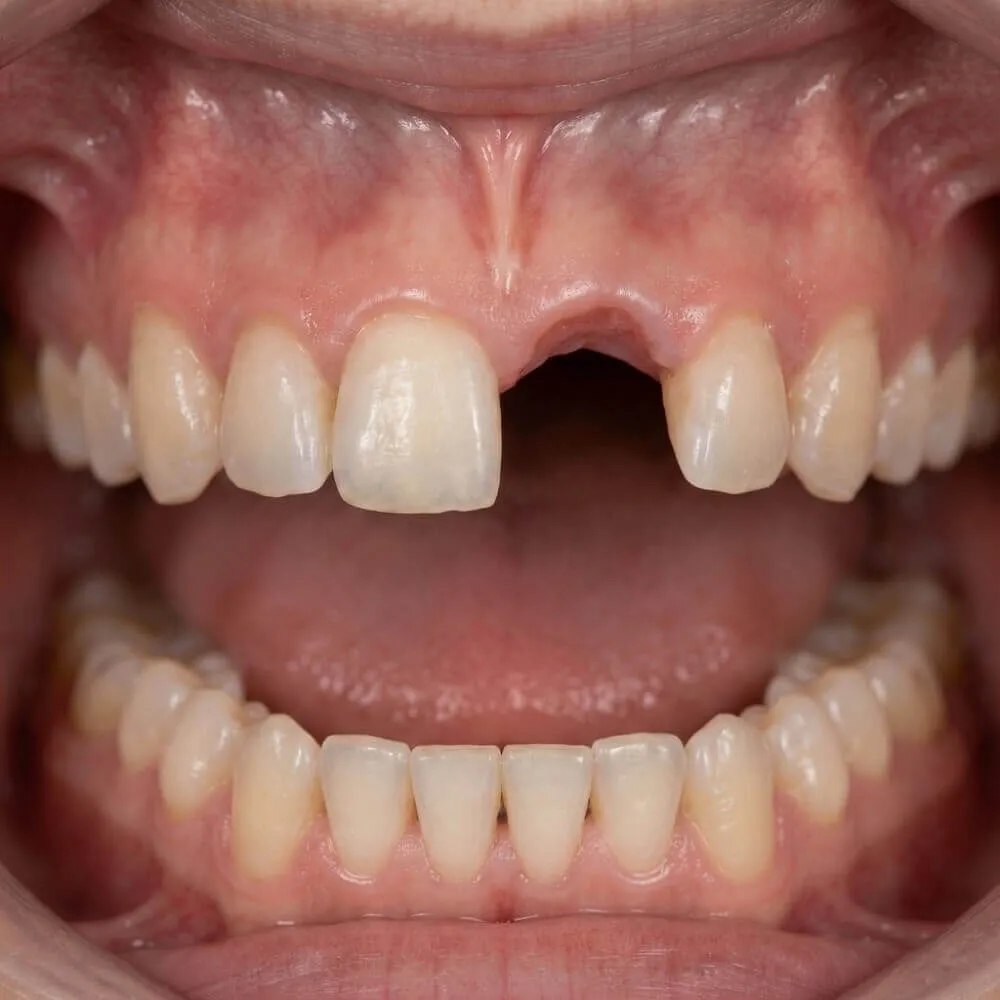 Close up of a missing upper front tooth before dental implant surgery in Cairo with Dina Elite VIP concierge 