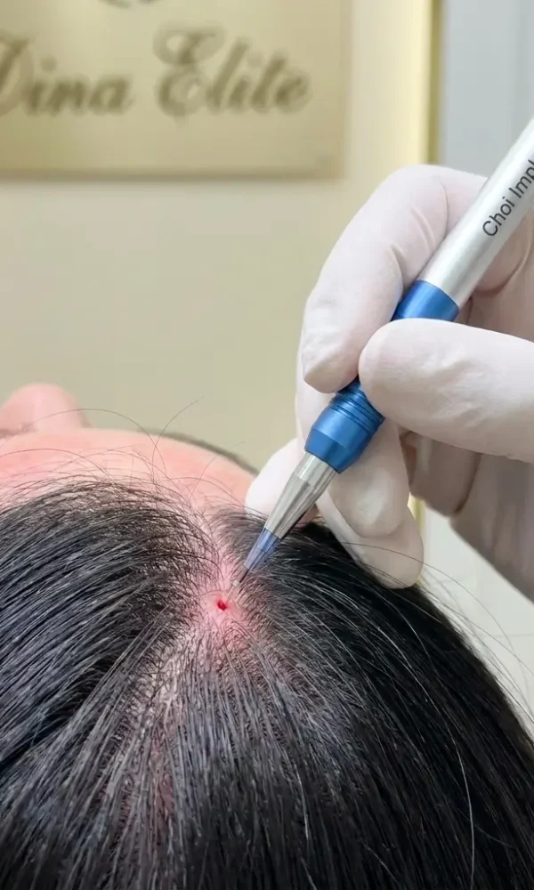 إجراء زراعة الشعر بتقنية DHI المباشرة باستخدام أقلام تشوي في مركز Dina Elite