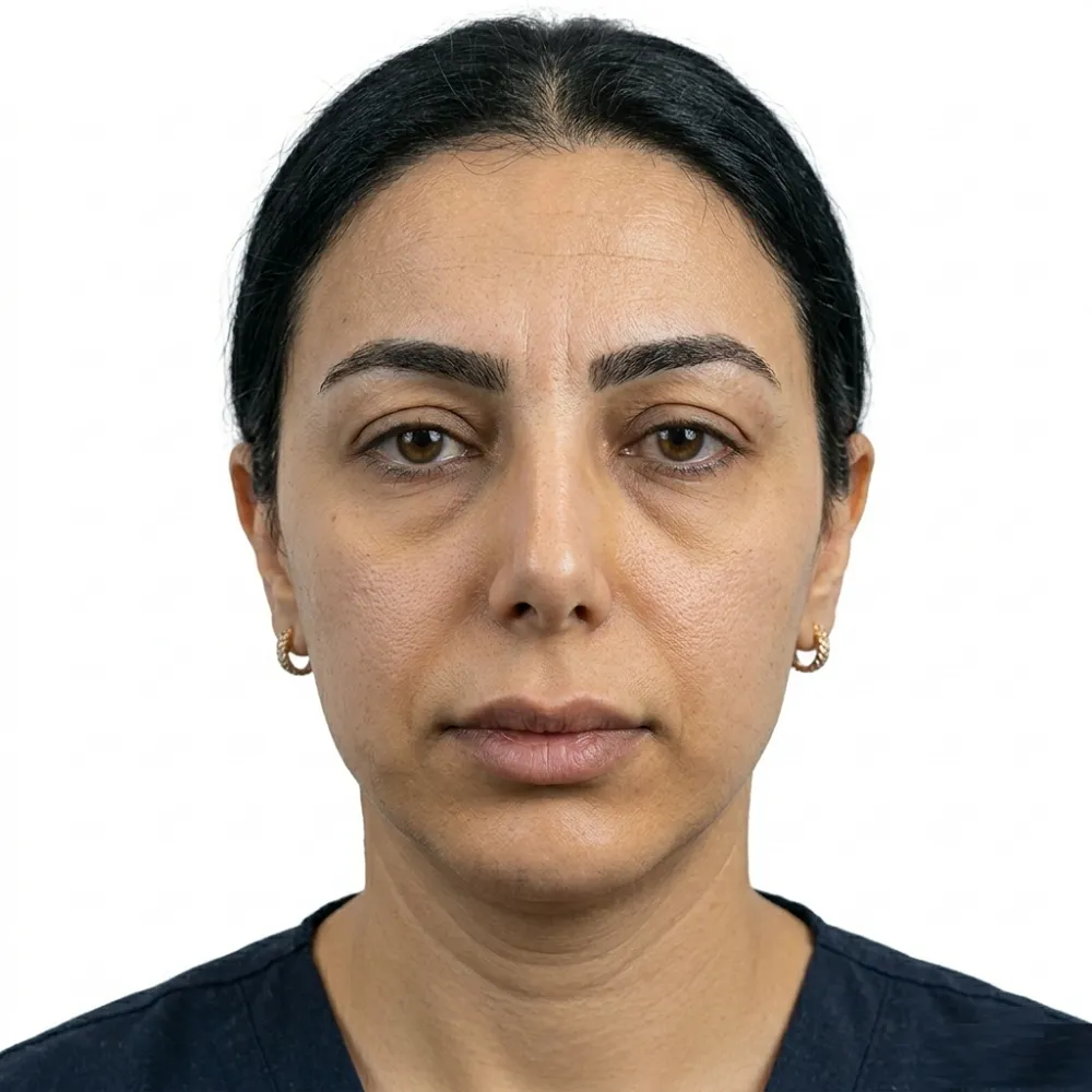 Detailed frontal clinical view of a distinguished Middle Eastern woman from the Gulf region presenting with heavy, sagging eyebrows and corresponding deep forehead wrinkles  Captured before an endoscopic keyhole brow lift surgery in Egypt  Targets patients from Riyadh and Dubai  Natural lighting 