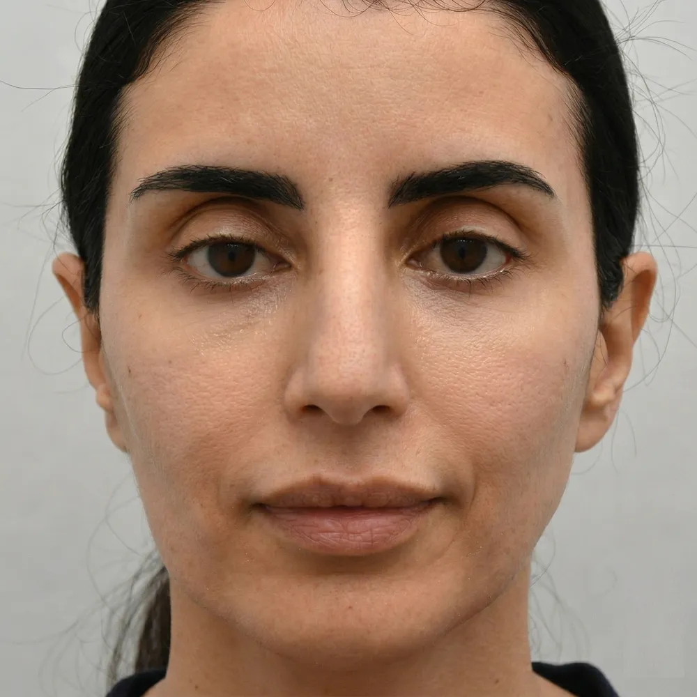 Close up transformation after Facial Fat Grafting (lipofilling) at Dina Elite Egypt, showing refined, natural volume restoration in the cheeks, lips, and contours with deep hydration  Targets high end clientele from Saudi Arabia, UAE, and Kuwait 