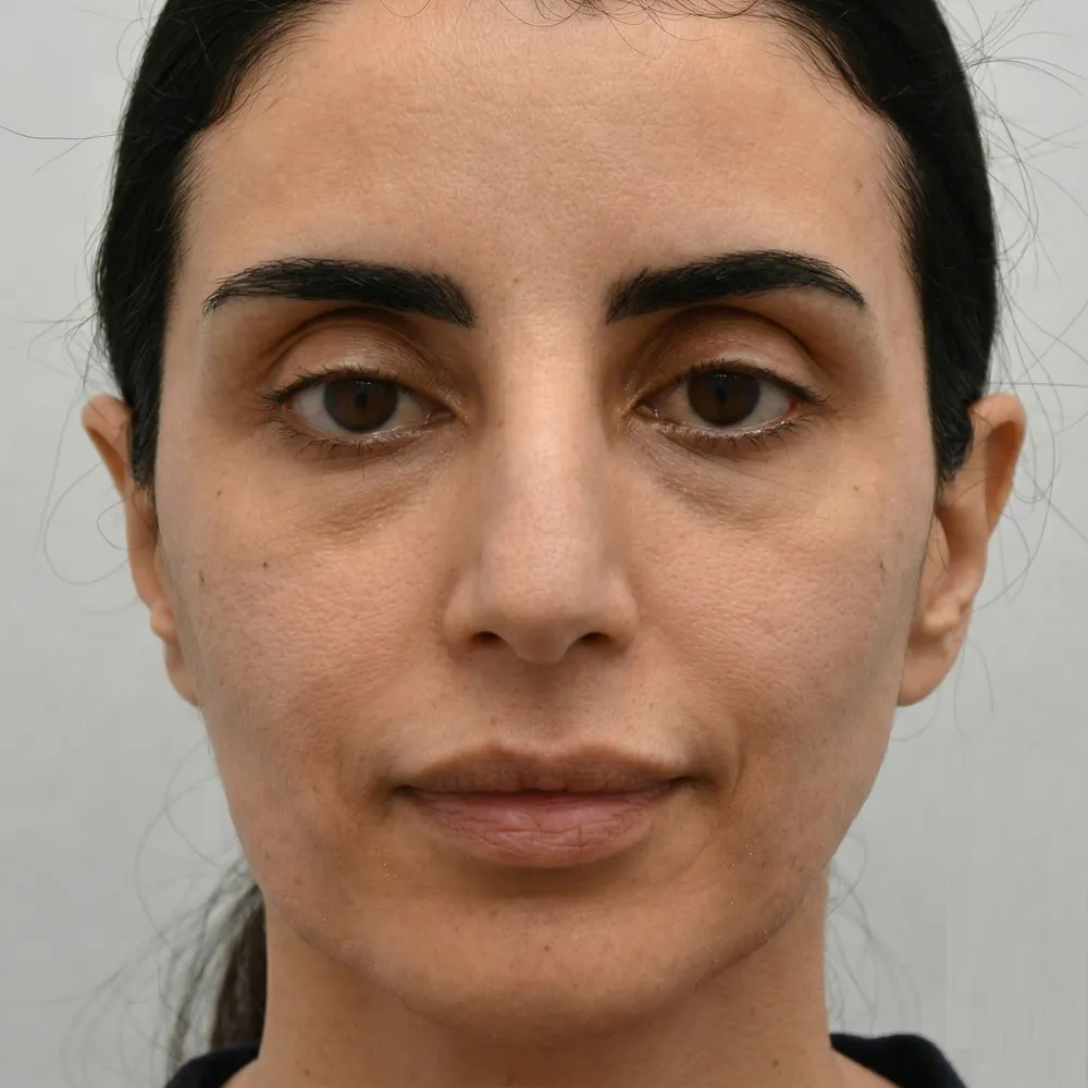 Detailed medical close up of a woman's lower face before structural lipofilling, highlighting hollow contours and marionette lines for concierge aesthetic surgery in Cairo, Egypt 