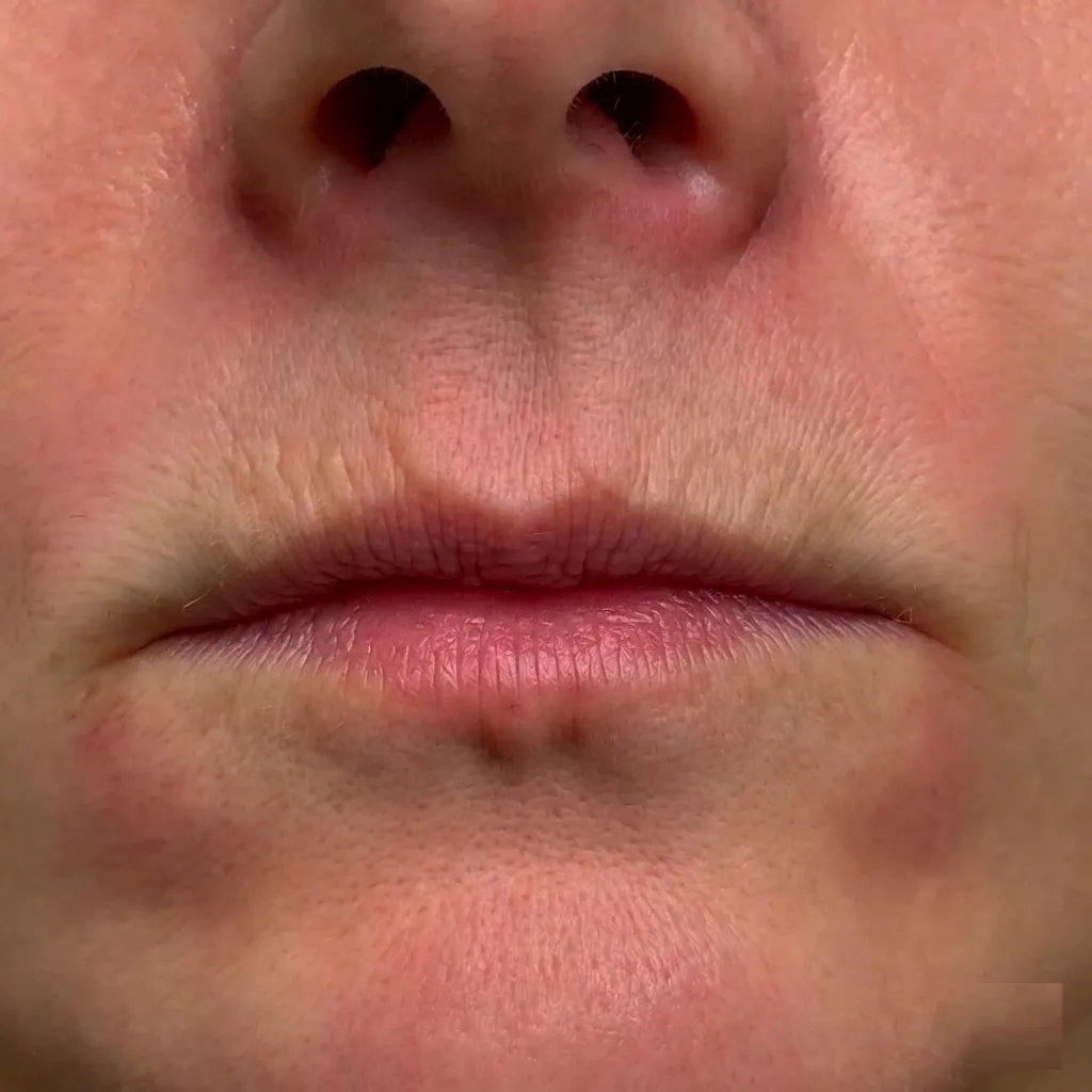 Close up clinical view of a patient before a Lip Lift procedure, showing a long philtrum and thin upper lip with visible aging lines 