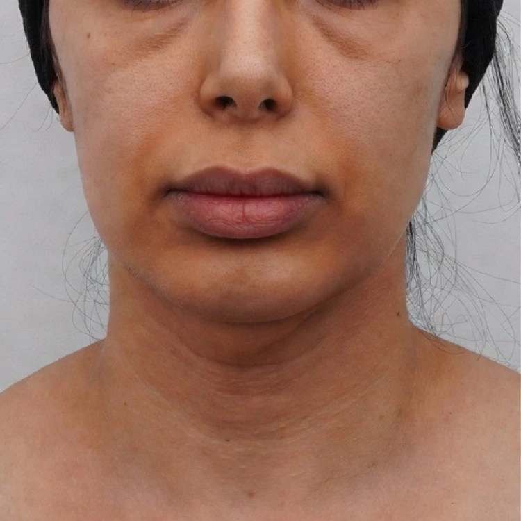 Detailed clinical profile of a woman showing sagging neck skin, a prominent double chin, and vertical platysmal bands before surgery in Cairo, Egypt  Targets clients in Riyadh and Dubai  1:1 aspect ratio 